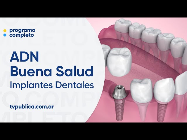 Implantes Dentales: ¿Duelen? ¿Cuánto duran? ¿Son seguros? - ADN Buena Salud