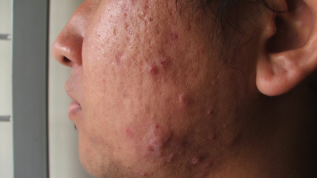 What Is Cystic Acne? | Acne Treatment - YouTube