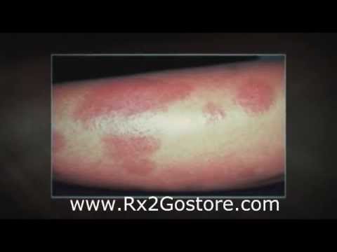 Mometasone Furoate Cream - How to Treat Psoriasis Effectively - YouTube