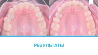 Лечение капами-элайнерами скученности зубов без удаления за 13 месяцев