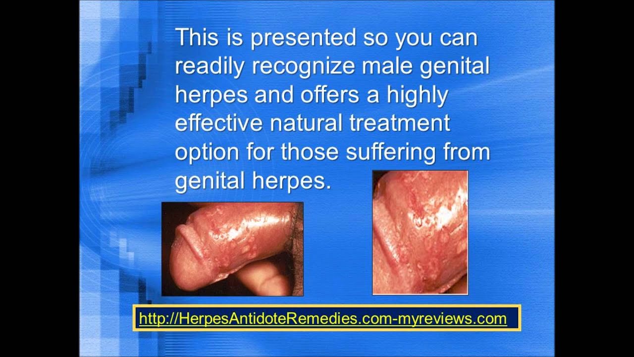 herpes on male genitalia