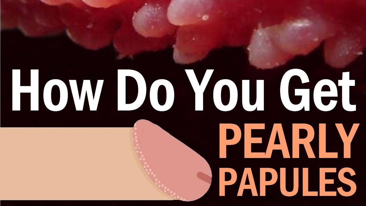 Pearly papules treatment
