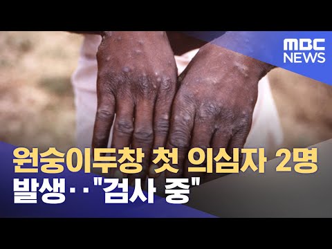 원숭이두창 첫 의심자 2명 발생‥"검사 중" (2022.06.22/930MBC뉴스)
