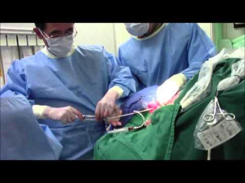 Hemodialysis Catheter Insertion By Quinton