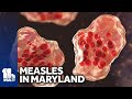 Health officials confirm measles case in Maryland