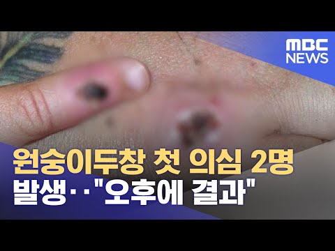 원숭이두창 첫 의심 2명 발생‥"오후에 결과" (2022.06.22/12MBC뉴스)