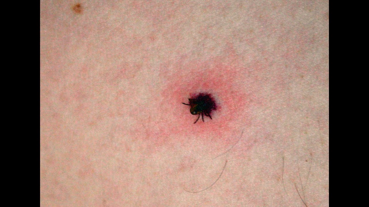 How To Remove A Tick DermTV Epi 512 YouTube