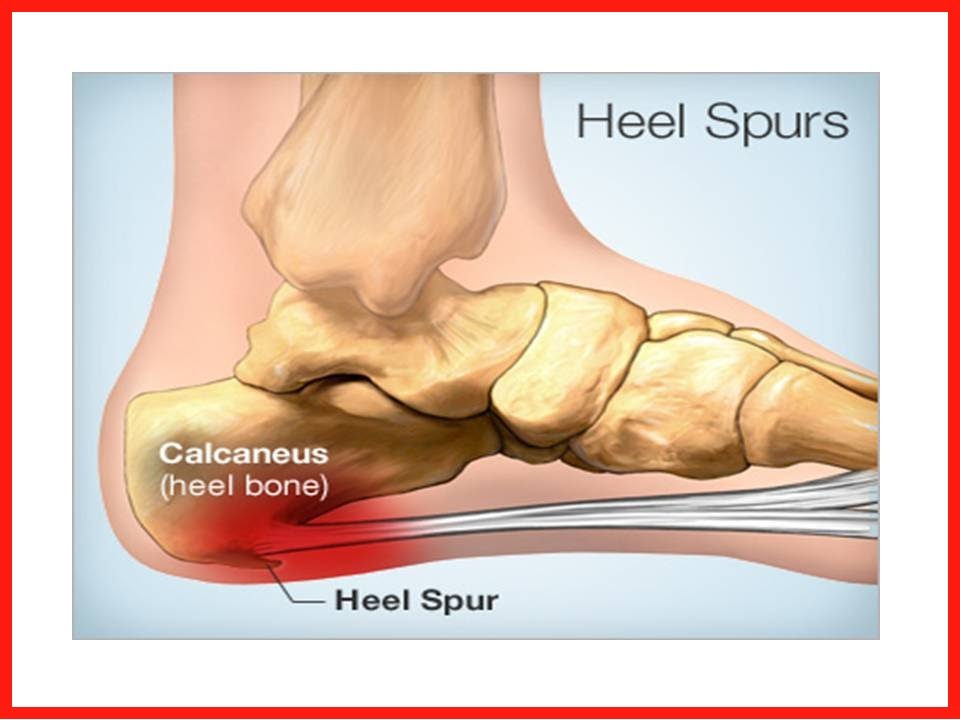 Pain In Heel Of Foot How To Get Rid Of Foot Pain Caused By Heel Spurs 