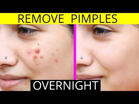 How To Remove Pimples Overnight | Acne Treatment | Anaysa