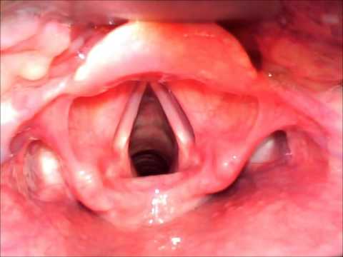Laryngoscopy - YouTube