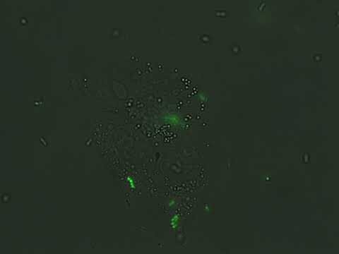 In this video, Salmonella, filled with Green Fluorescent Protein, have invaded breast cancer cells. Once the bacteria sense that they are inside the cell, they self-destruct and release the fluorescent protein throughout the cancer cell. This video demonstrates how Salmonella can delivery therapeutic proteins into tumor cells.