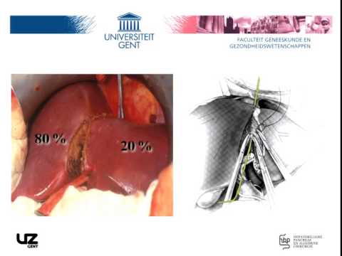 Split-liver Transplantation technique and outcome 