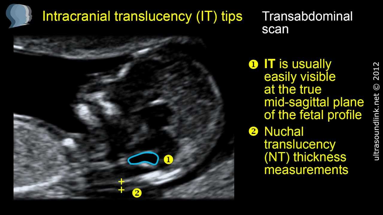 Intracranial translucency (IT) tips and tricks - YouTube