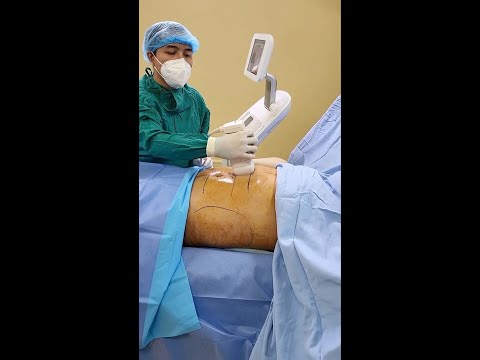 Super ultrasound Liposonix fat suction