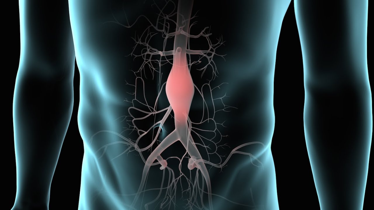 Endovascular Abdominal Aortic Aneurysm Repair AAA Repair YouTube