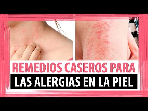 Las causas del surgimiento de la psoriasis y los síntomas