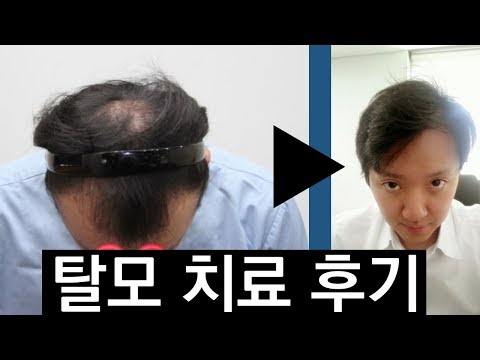 탈모 치료 후기, 실제로 경험한 탈모 치료법 이야기입니다