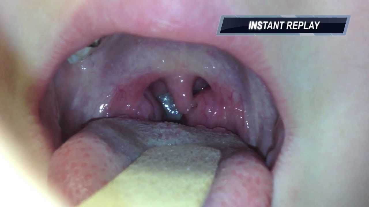 Drainage From Eye To Throat 40