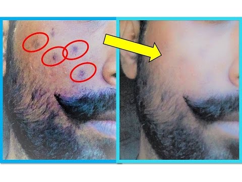 Beauty Tips for MEN / Fast Remove DARK SPOT from your face / Home Remedies for Men in Hindi