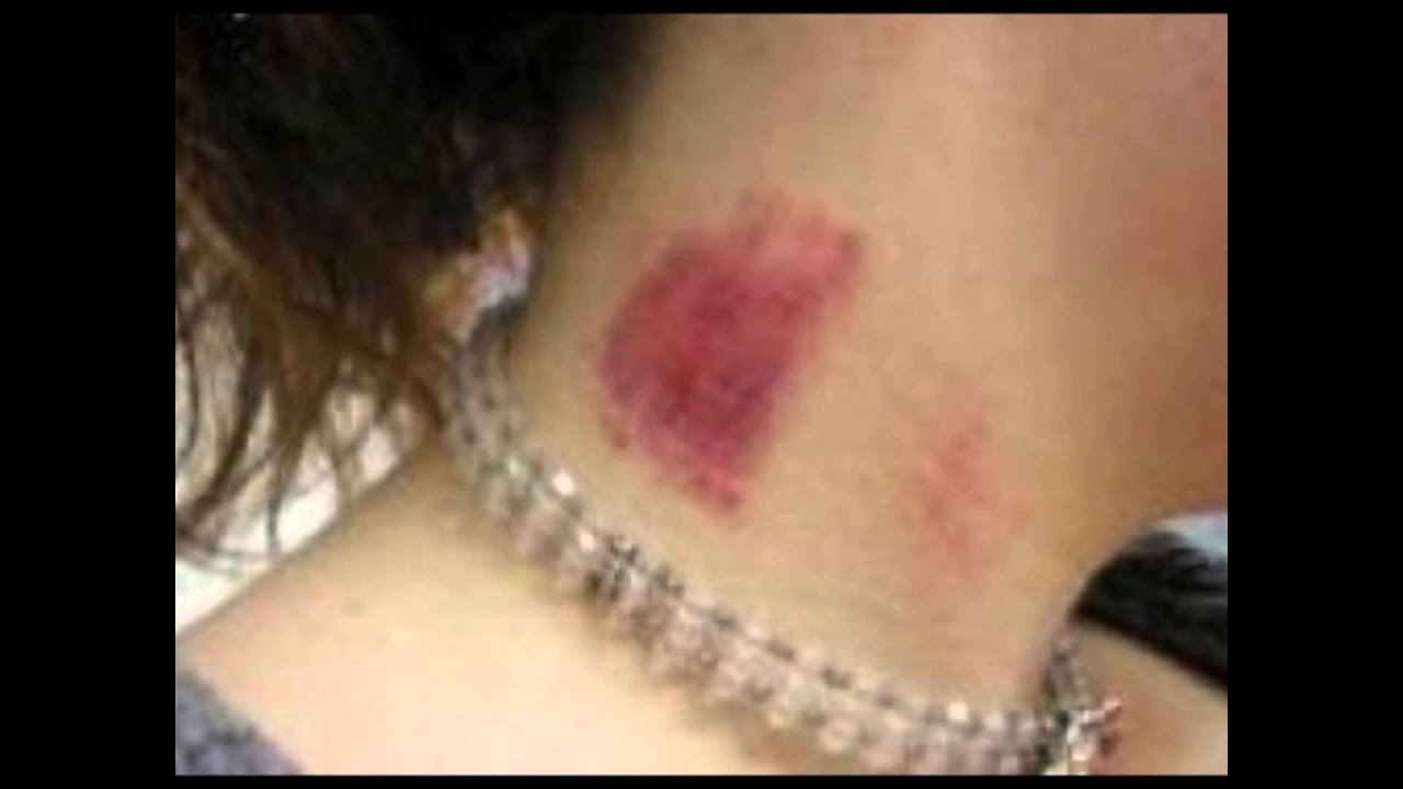 how-to-get-rid-of-a-hickey-how-to-get-rid-of-a-hickey-fast-how-do