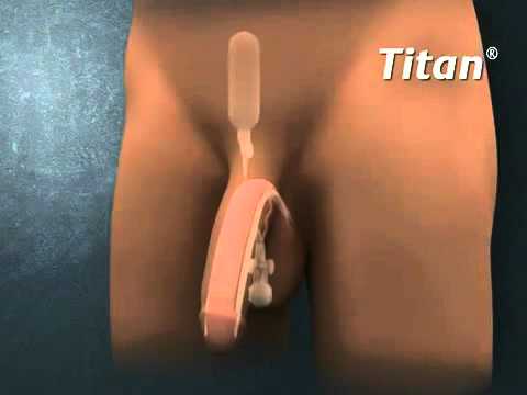Penis Implant Video 83