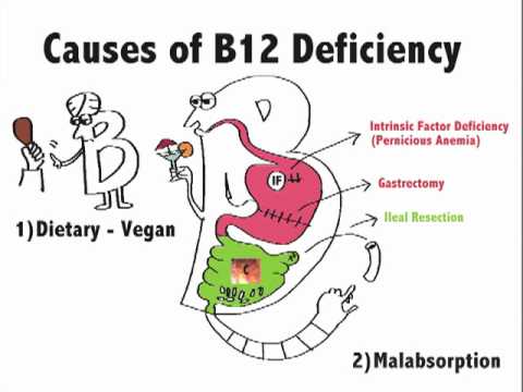 Causes Of B12 Deficiency - YouTube