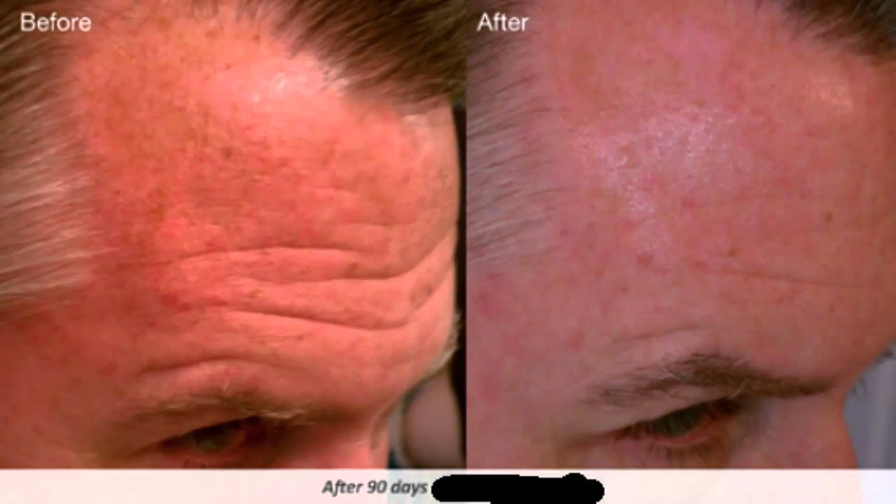 best-treatment-for-deep-forehead-wrinkles-youtube