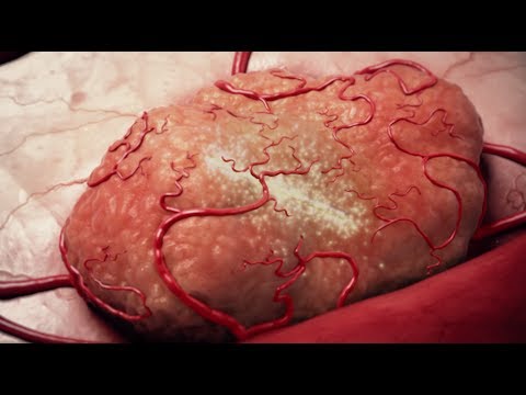 Alpha DaRT by Alpha Tau Medical Alpha DaRT by Alpha Tau Medical