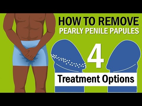 How to Remove Pearly Penile Papules - 4 Treatment Options