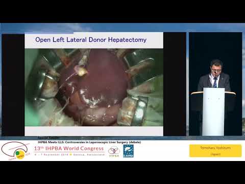 SS02.4 IHPBA Meets ILLS: Controversies in Laparoscopic Liver Surgery