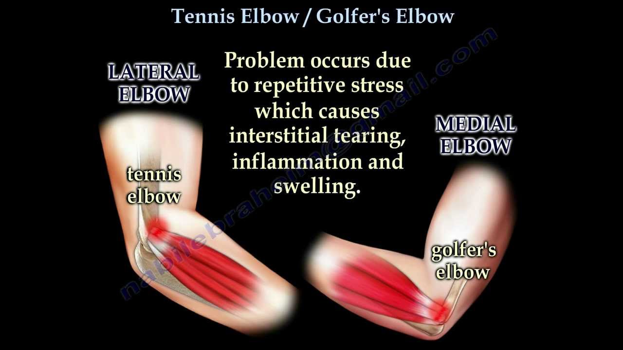 Tennis and golf elbow