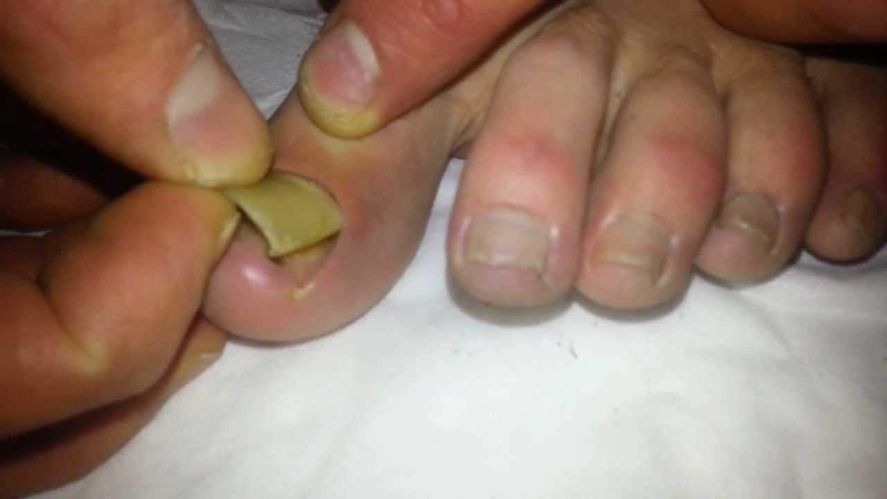 removal-of-dead-toenail-youtube