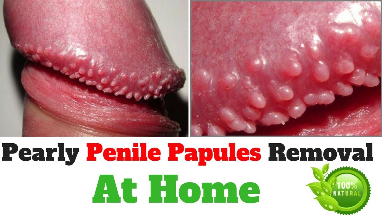 Penile treatment natural pearly papules Remedies &