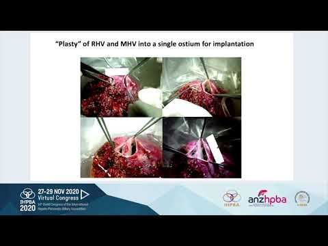 MTP08 - Technical Innovations: Arterial and Venous Reconstruction in Liver Transplantation