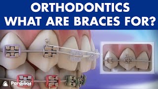 How Braces Work- Elements of the orthodontic treatment and its role ©