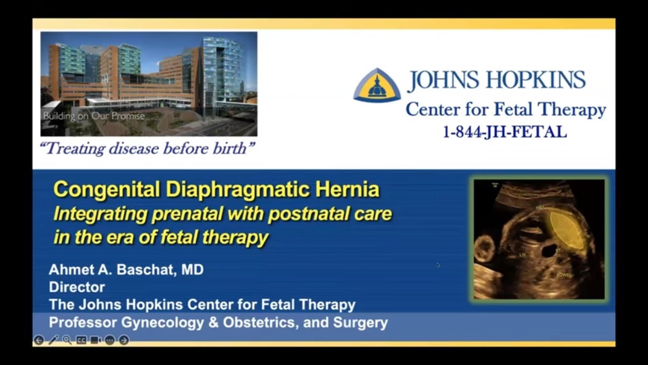 Management Advances for Congenital Diaphragmatic Hernia—Integrating Fetal and Postnatal Care Webinar