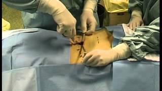 operatie laparoscopica prostata folosind un magnet pentru prostatita