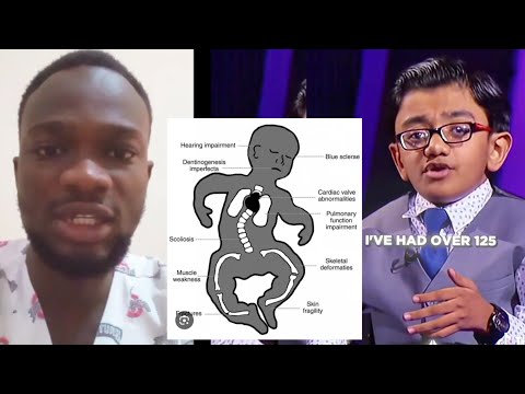 He Was Born With Brittle Bone Disease | Physician Reacts 