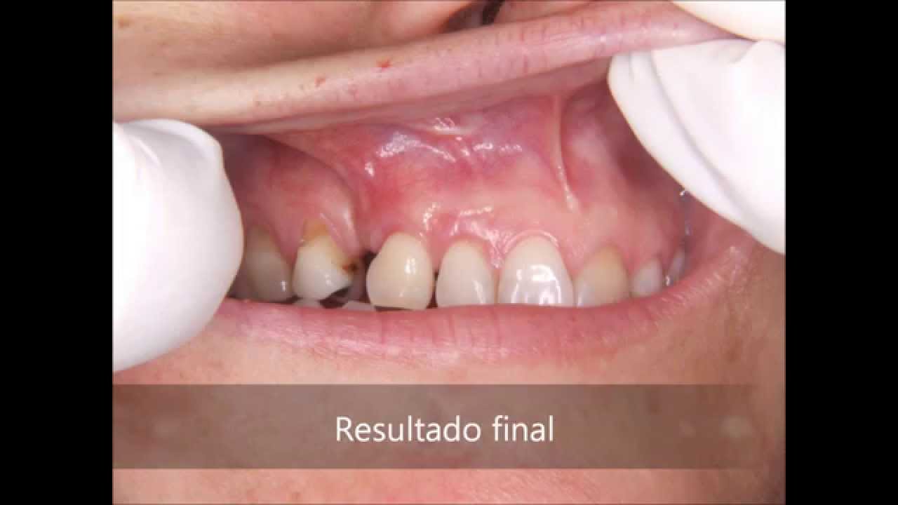 Cirurgia plástica gengival - www.blosodontologia.com.br - YouTube