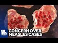 Health officials concerned over rise in measles cases