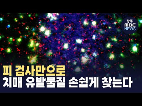 [뉴스데스크]피 검사만으로.. 치매 조기 진단법 찾았다