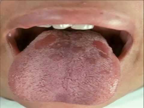 syphilis - fmc - esculape.com