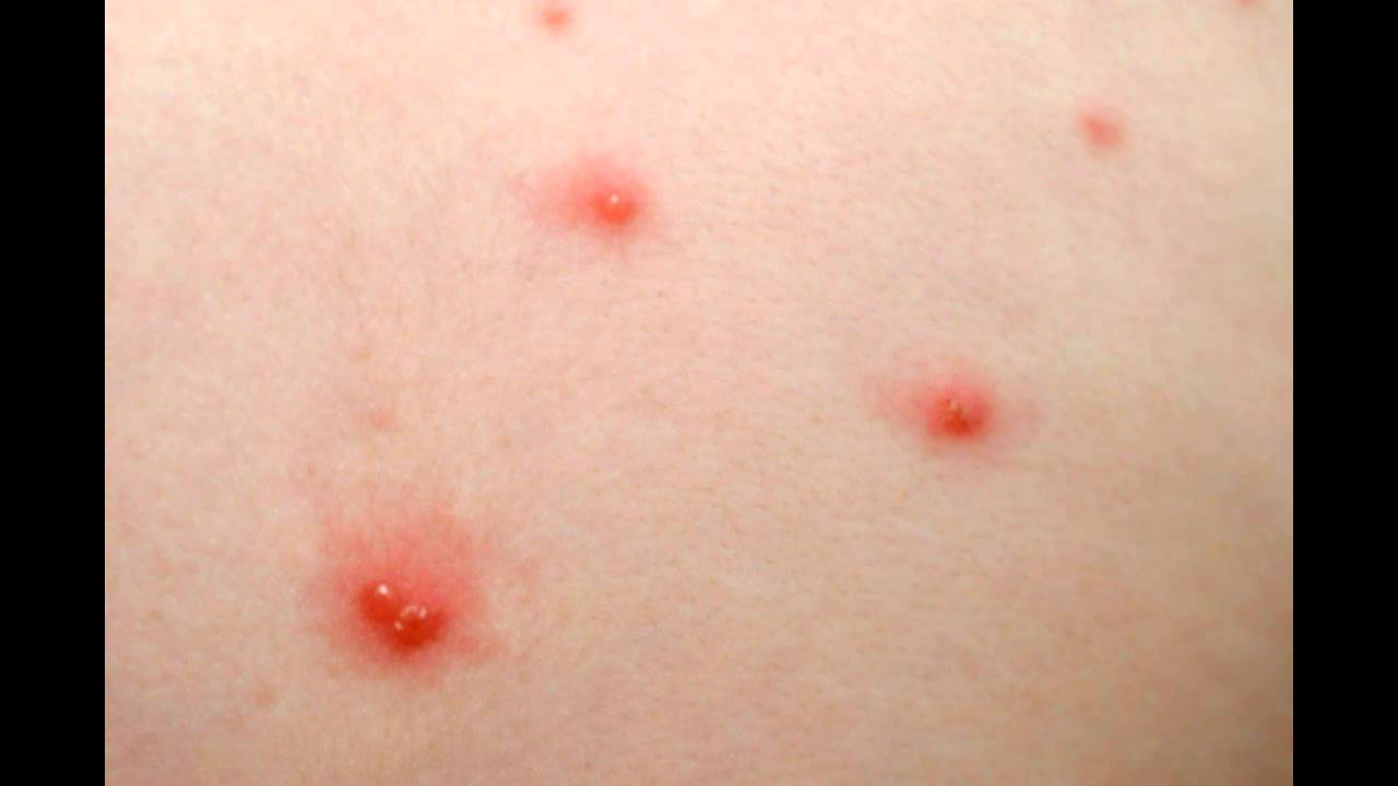 Shingles (Herpes Zoster) | Health | Patient