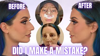 CLOSED RHINOPLASTY NOSE JOB VLOG | SURGERY DAY, DAY BY DAY RECOVERY & CAST REMOVAL REVEAL