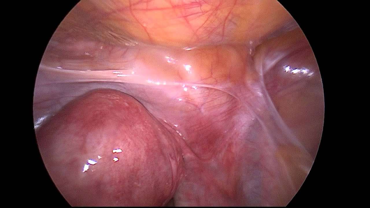 Fibroid Uterus Retroverted Uterus Ventrosuspension Infertility