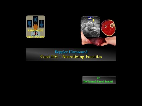 Upload mp3 to YouTube and audio cutter for Ultrasound Case 116 - Necrotizing Fasciitis & Critical Limb Ischaemia download from Youtube