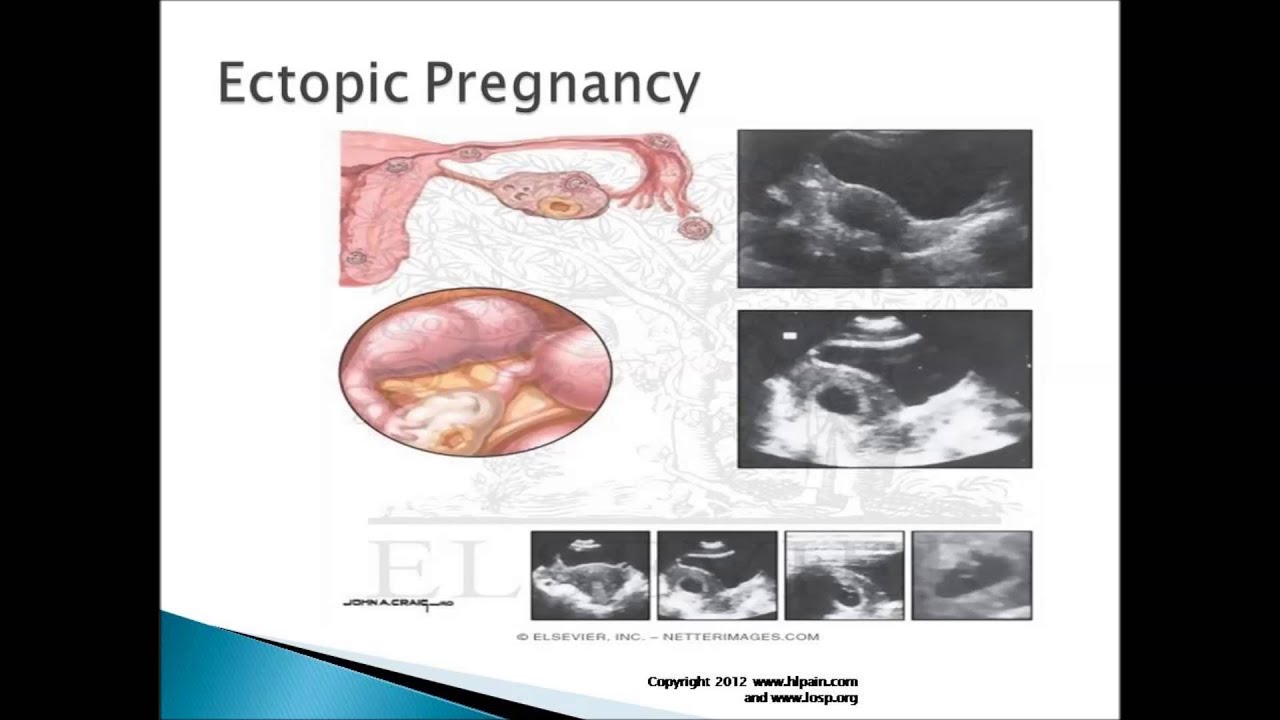 Pain In Lower Left Side Of Stomach Symptoms Causes And Treatment YouTube