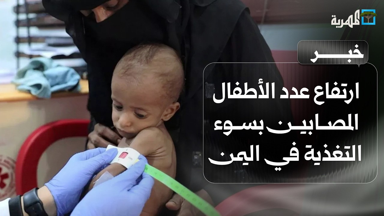 أطباء بلا حدود تؤكد ارتفاع عدد الأطفال المصابين بسوء التغذية في اليمن