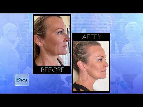 Dina BenDavid recently featured on Emmy award-winning daytime talk show The Doctors demonstrating her signature "cheek pop" technique on her patient using PDO Max Threads.