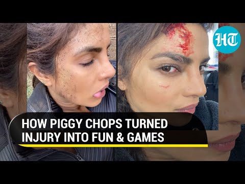 Priyanka Chopra injured on sets of Citadel, wants you to identify fake and real wound Priyanka Chopra injured on sets of Citadel, wants you to identify fake and real wound